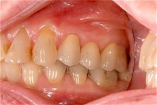 Ceramic Crowns after