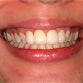 Crowns and Veneers after