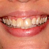 crowns and veneers before