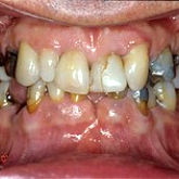 Full Mouth Rehabilitation