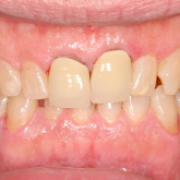 Veneers and Crowns before