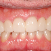 Veneers and Crowns after