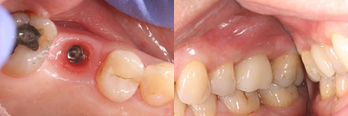 Broken Tooth Repair  Cracked Tooth Dentist Rockville Centre, NY