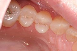 Broken Tooth Repair  Cracked Tooth Dentist Rockville Centre, NY