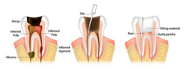 endo treatment